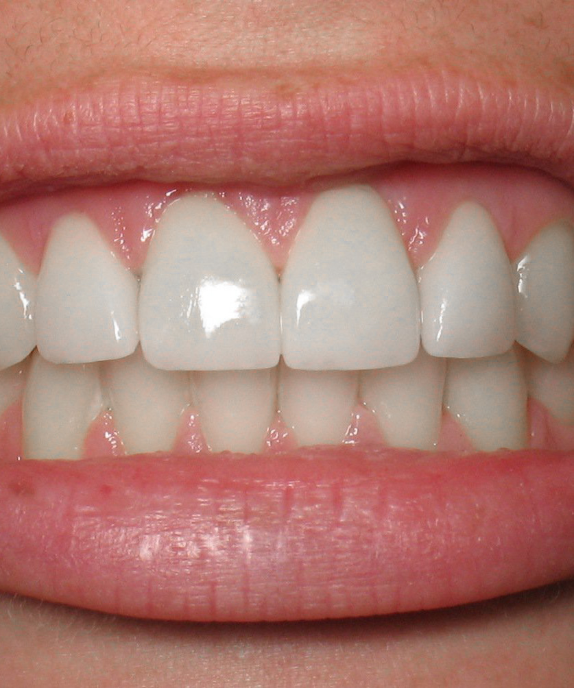 Форма зубов клыки. Идеальные зубы. Идеально ровные зубы. Красивая форма зубов.