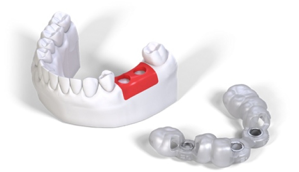 Виды зубных имплантов, их строение и формы