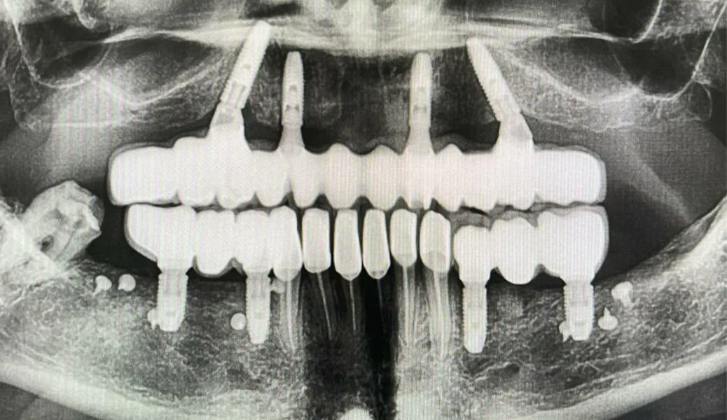 Имплантация зубов: виды и способы