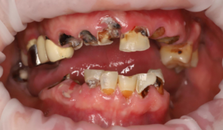 Как тотальное восстановление зубов может изменить жизнь