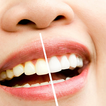 Причины изменения цвета эмали зубов
