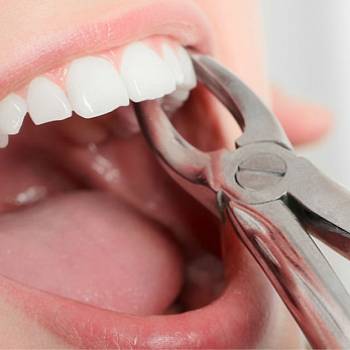 Почему зубы нужно удалять правильно и как это влияет на успех имплантации