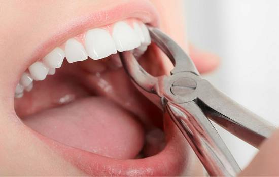 Почему зубы нужно удалять правильно и как это влияет на успех имплантации