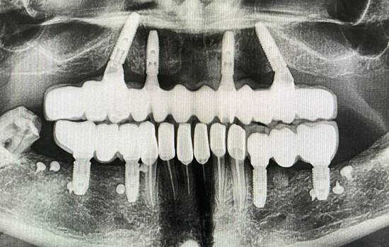Имплантация зубов: виды и способы