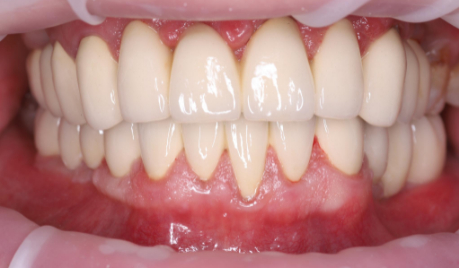 Как тотальное восстановление зубов может изменить жизнь