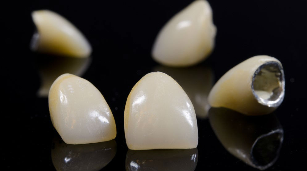 Зубна металлокерамическая коронка на имплантатах